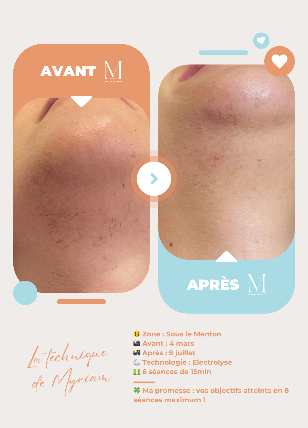 Epilation électrolyse - Menton et cou